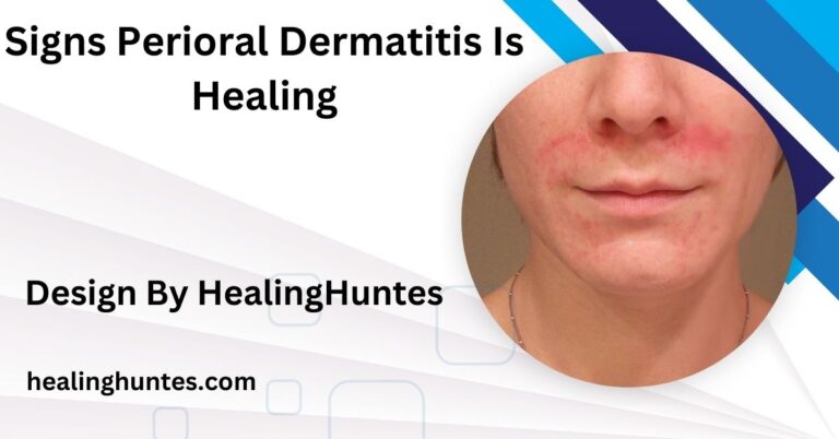 Signs Perioral Dermatitis Is Healing – Identifying Healing Symptoms!