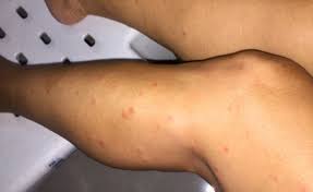 Understanding No-See-Um Bites:
