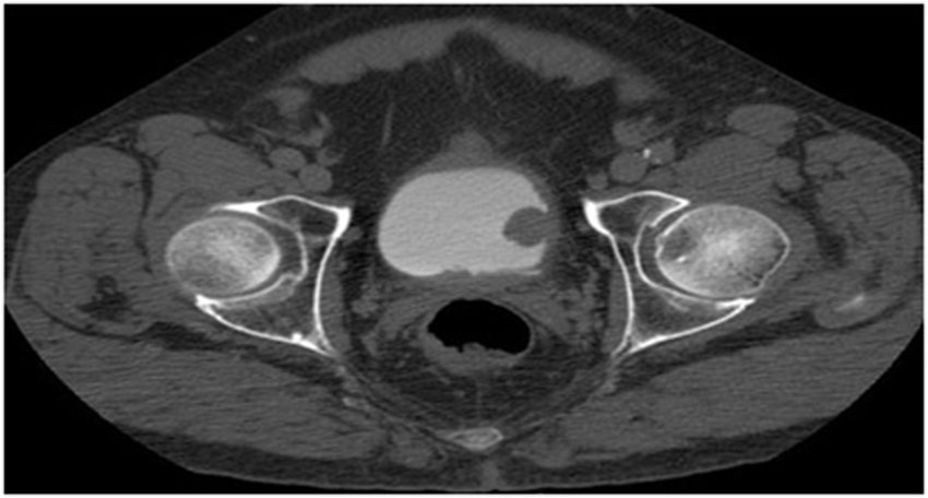 What Are Bladder Polyps?