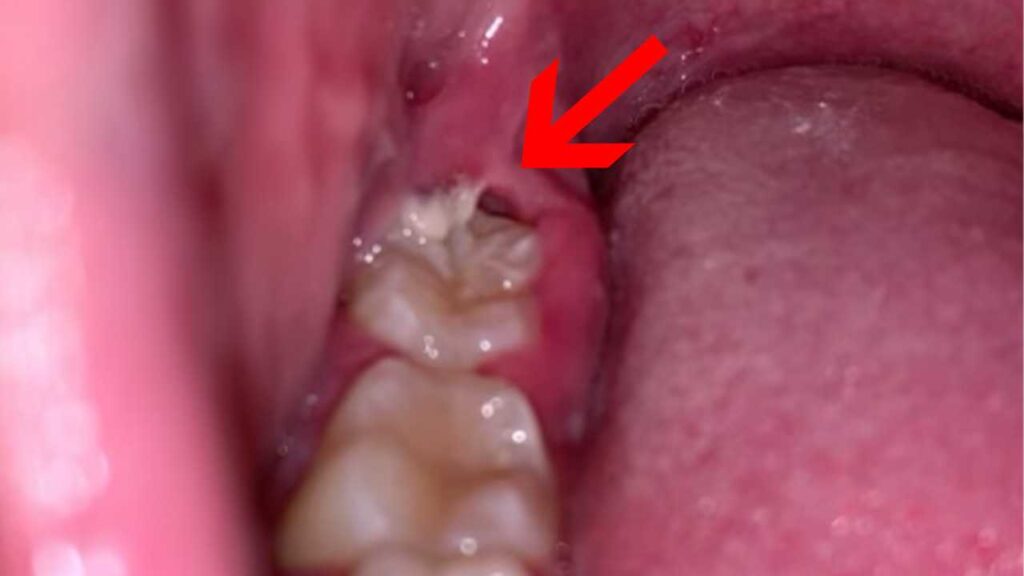Swelling or Bruising After a Week: Possible Signs of Infection: