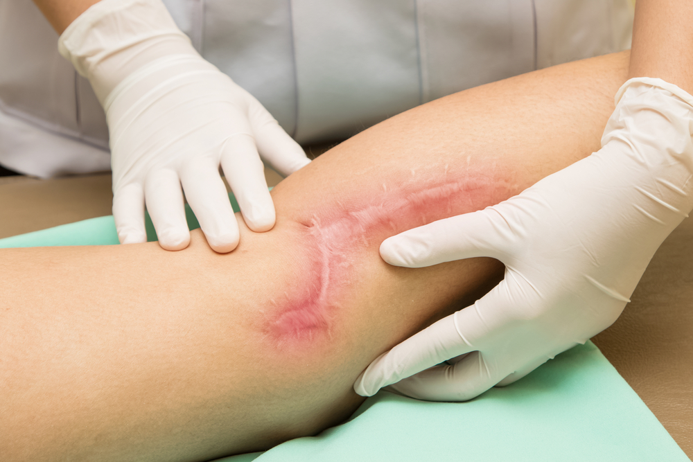Preventing Scars During Healing: